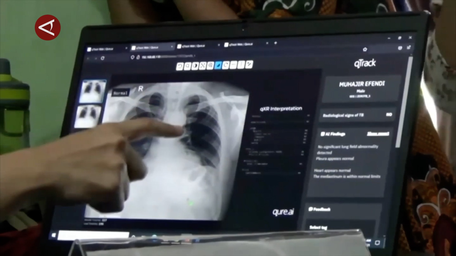 TBC bagai fenomena gunung es, PDPI ingatkan urgensi deteksi dini